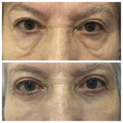 Blefaroplastia en Madrid - Dra. Hincapié