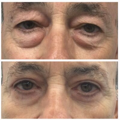 Blefaroplastia en Madrid - Dra. Hincapié