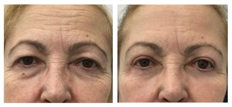 Cirugía de blefaroplastia superior e inferior para eliminar bolsas y exceso de piel en la clínica de la Dra. Hincapié en Madrid.