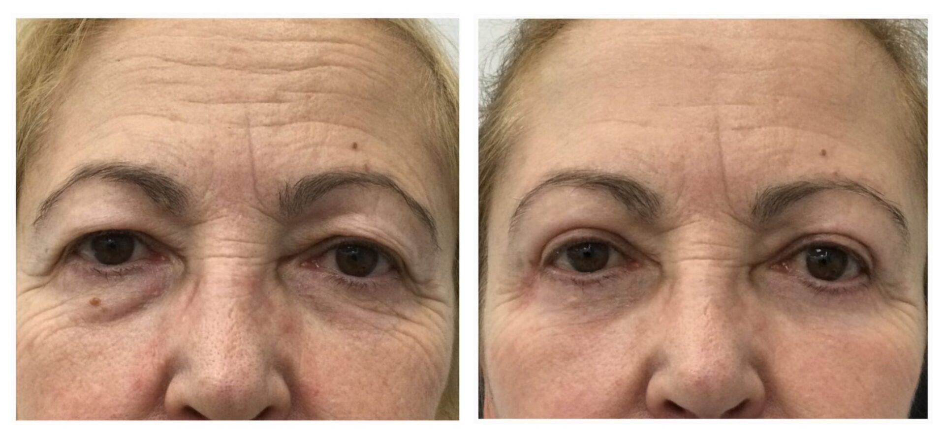 Cirugía de blefaroplastia superior e inferior para eliminar bolsas y exceso de piel en la clínica de la Dra. Hincapié en Madrid.