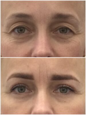 Blefaroplastia con láser CO2. " Mirada rejuvenecida, natural y sin cicatrices visibles." | Doctora Hincapié