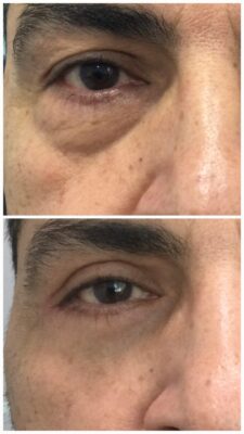 Blefaroplastia con láser CO2. " Mirada rejuvenecida, natural y sin cicatrices visibles."
