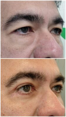 Blefaroplastia completa con Láser. "Mirada más joven y un resultado natural" | Doctora Hincapié