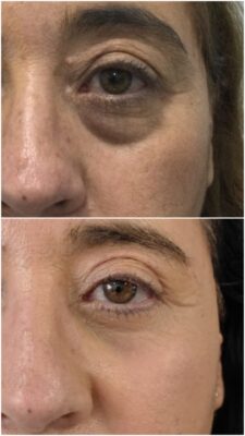 Blefaroplastia transconjunitival con Láser. "Mirada natural y fresca" | Doctora Hincapié
