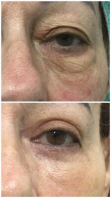 Blefaroplastia completa. "Mirada más abierta y mejor calidad de piel" | Doctora Hincapié