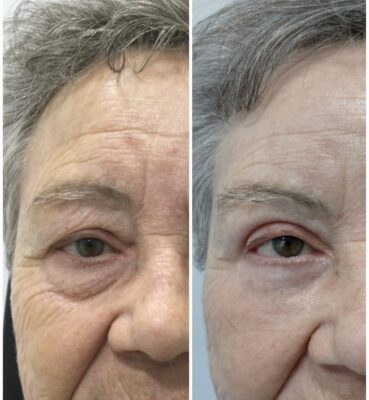 Blefaroplastia de párpado superior e inferior con LÁSER. Mirada rejuvenecida, piel tersa y luminosa | Doctora Hincapié