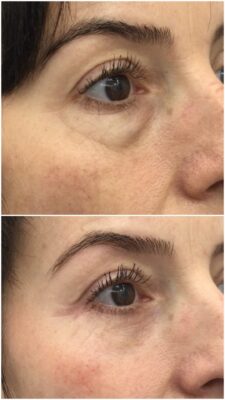 Blefaroplastia transconjuntival. "Mirada rejuvenecida SIN cicatriz visible" | Doctora Hincapié