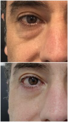Blefaroplastia de párpado inferior/bolsas con LÁSER, SIN CICATRIZ visible. "Resultado natural sin perder tu esencia" | Doctora Hincapié