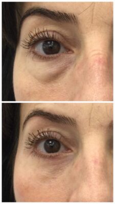 Blefaroplastia inferior con LÁSER "mirada descansada y SIN BOLSAS" | Doctora Hincapié