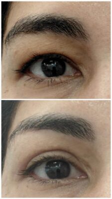 Blefaroplastia del párpado superior con Láser. "Mirada más abierta y natural" | Doctora Hincapié