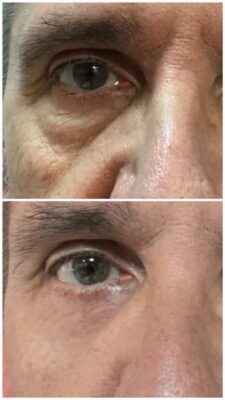Blefaroplastia de párpados inferior y minilifting de tercio medio con láser. "Mirada descansada que conserva su esencia" | Doctora Hincapié